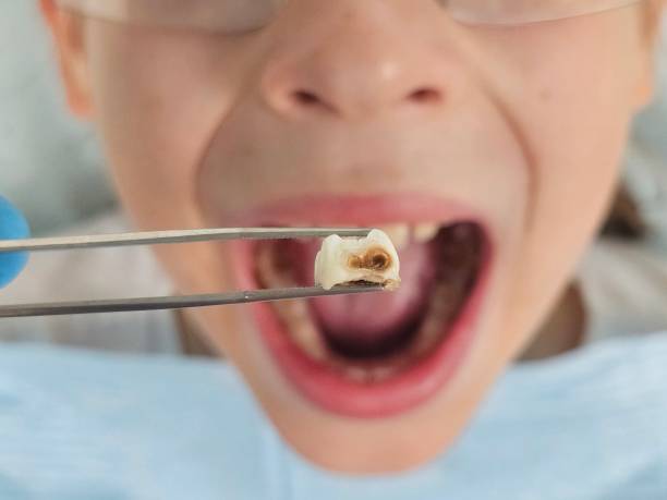 Best Knocked-Out Tooth Emergency  in Monroe, WA